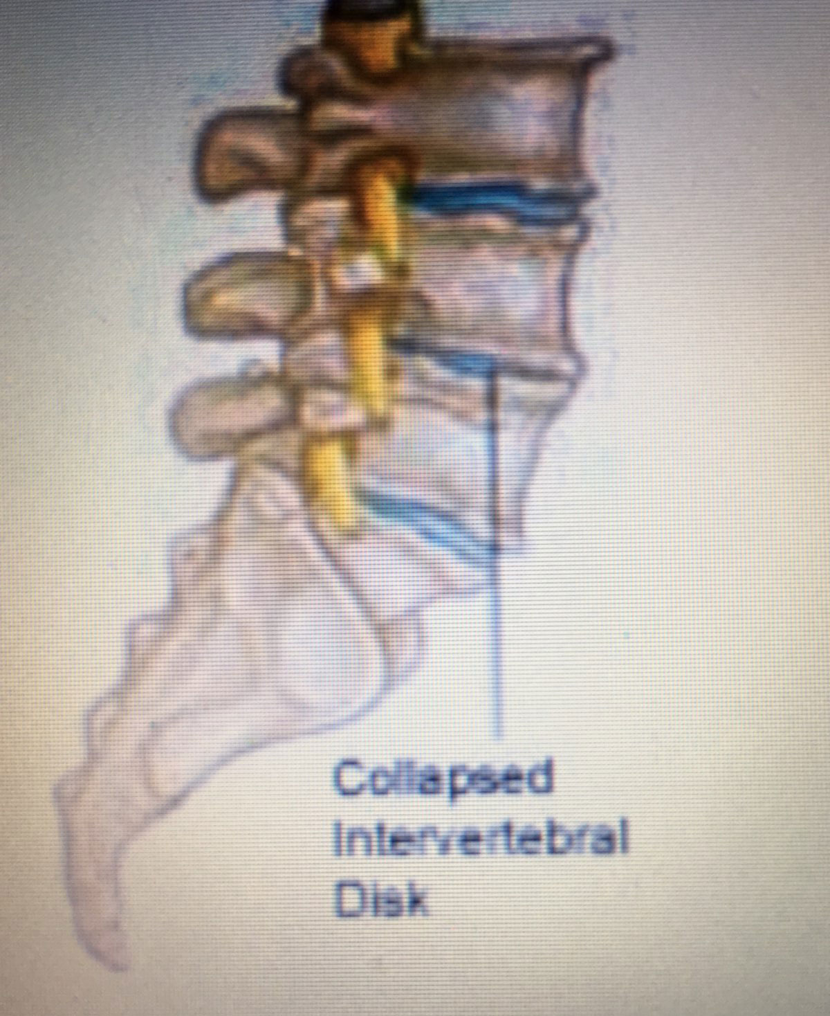 Collapsed Disk Physical Rehabilitation Clinton Township Michigan, Collapsed Intervertebral Disk Physical Rehabilitation Clinton Twp MI